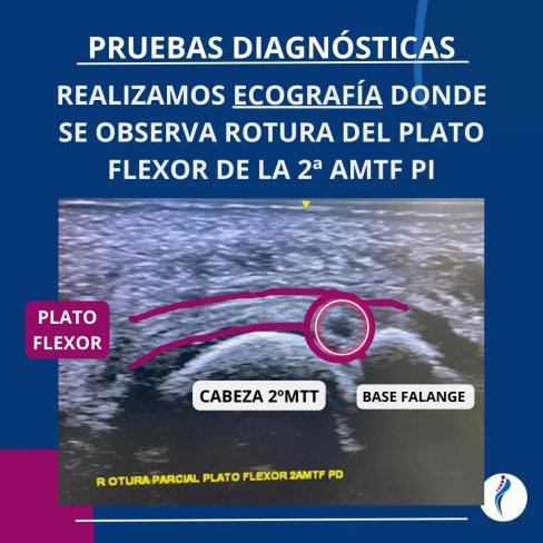 ROTURA DEL PLATO FLEXOR EN 2 ARTICULACIN METATARSOFALNGICA (Articulacin del segundo dedo)